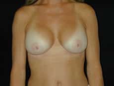 Procedure before and after - after