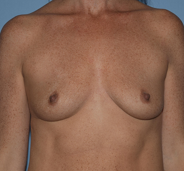 Breast Augmentation before and after - before