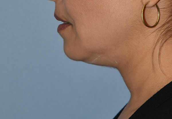 Double Chin Correction before and after - before