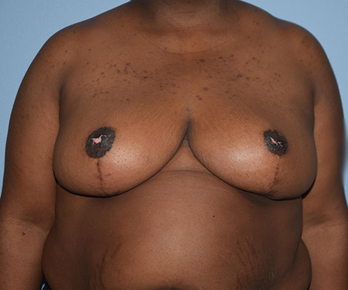Breast Lift before and after - after