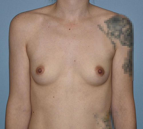 Breast Augmentation before and after - before