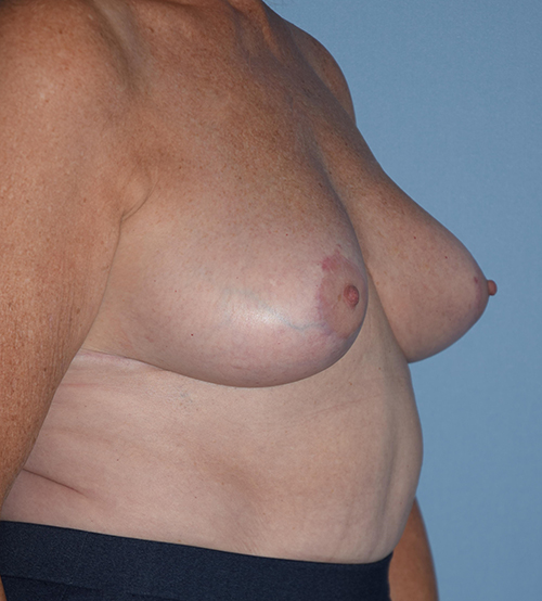 Breast Lift before and after - after