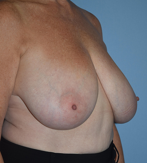 Breast Lift before and after - before
