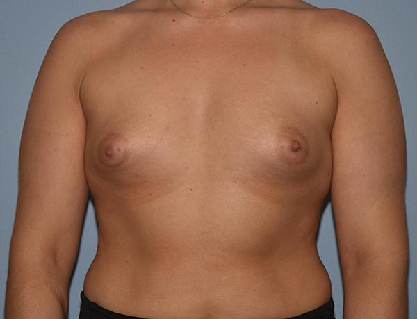 Breast Augmentation before and after - before