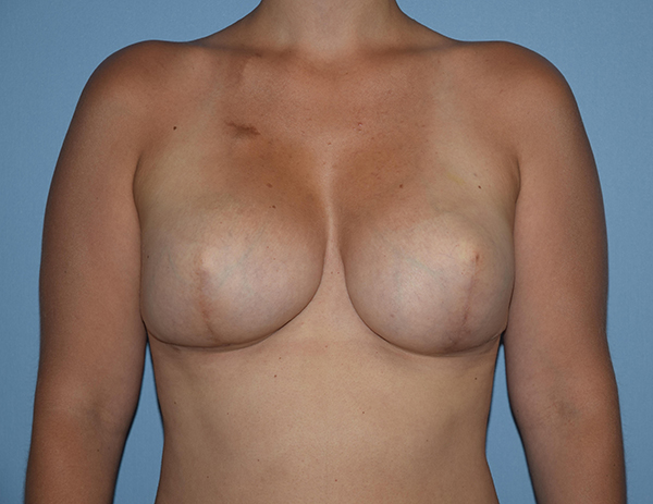 Breast Reconstruction (Implants) before and after - after