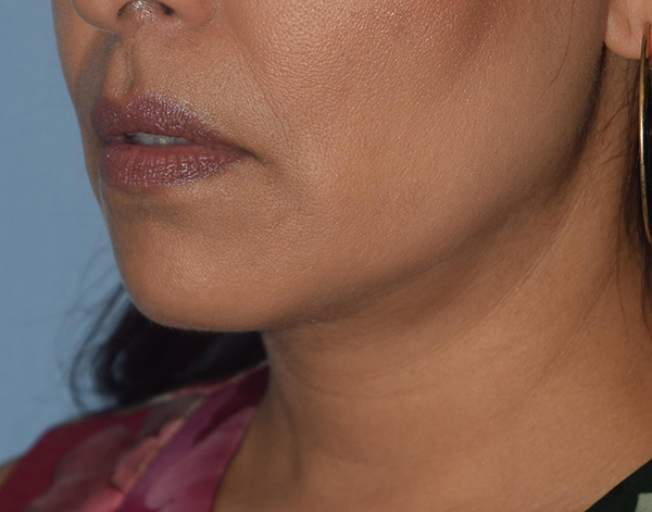 Double Chin Correction before and after - after