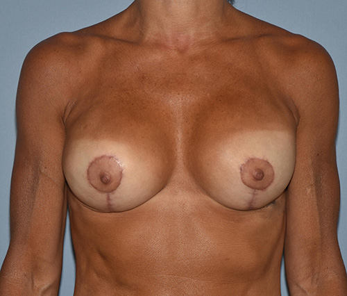 Breast Reconstruction (Implants) before and after - after