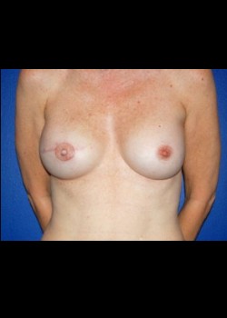 Procedure before and after - after