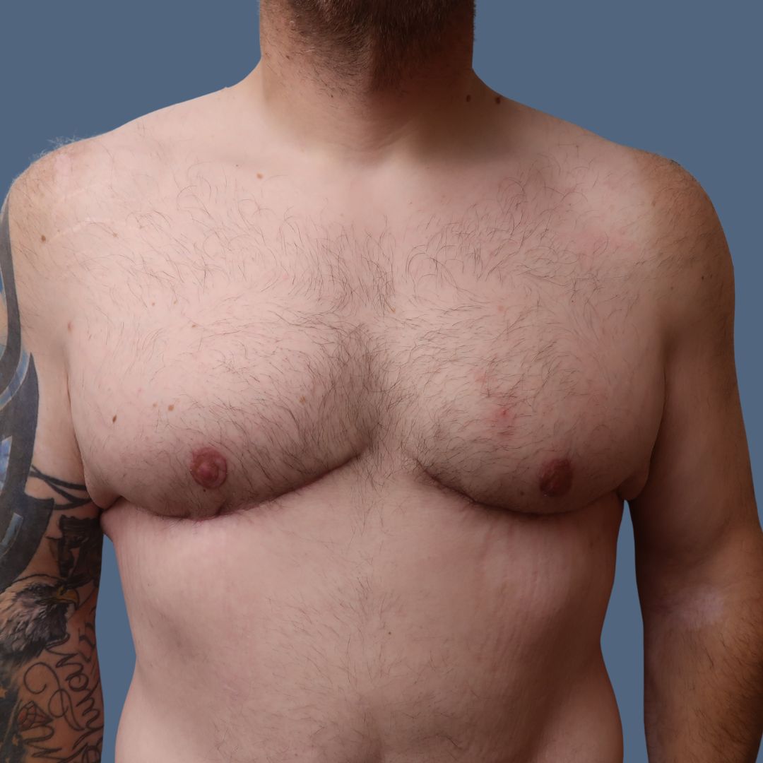 Breast Reduction before and after - after