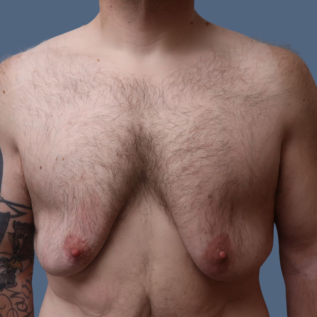 Breast Reduction before and after - before