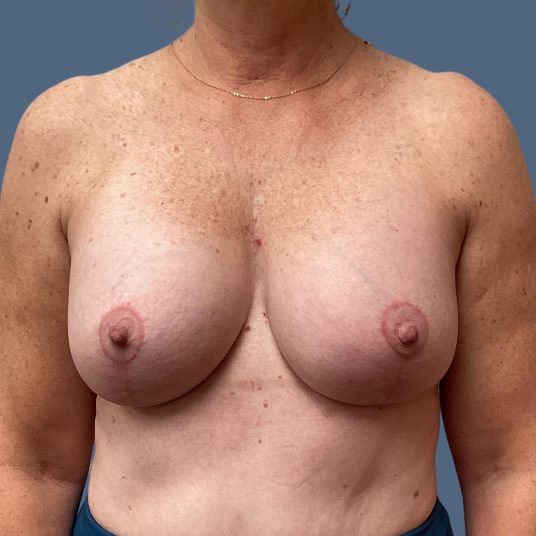 Breast Augmentation before and after - after