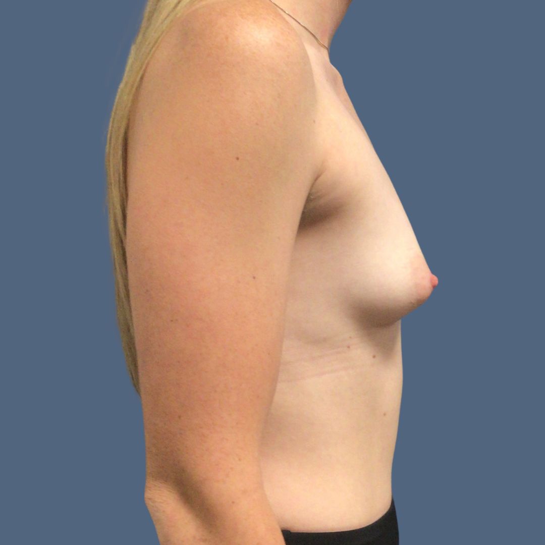 Breast Augmentation before and after - before
