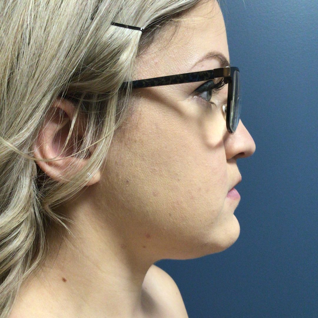 Liposuction before and after - before