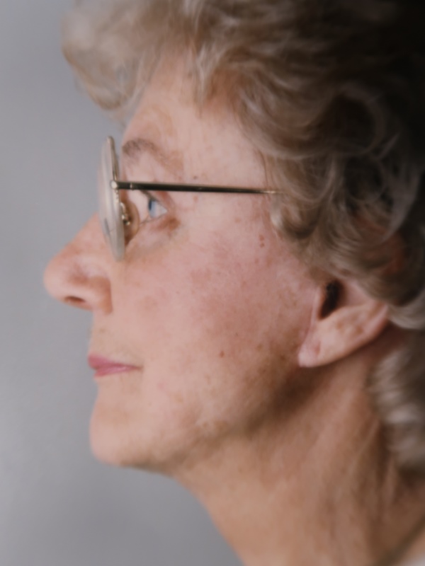 Facelift before and after - after