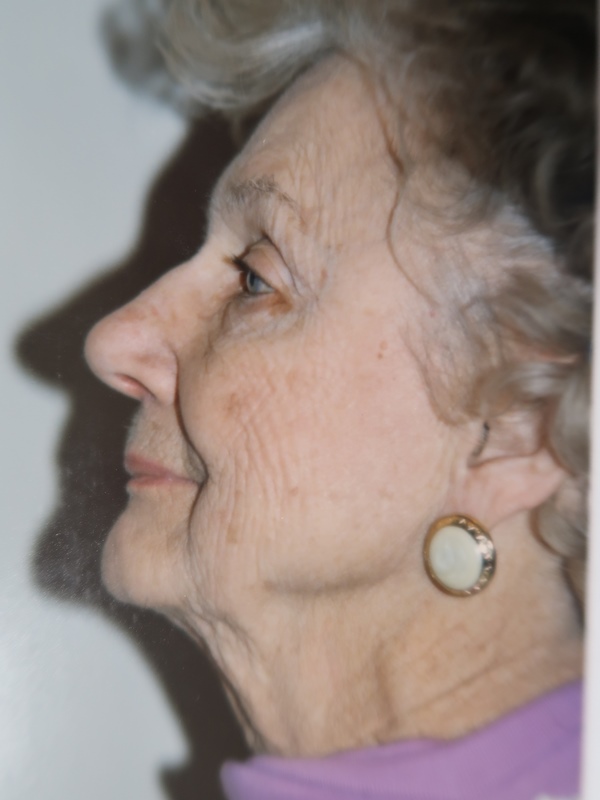 Facelift before and after - before