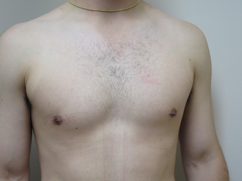 Breast Reduction before and after - after
