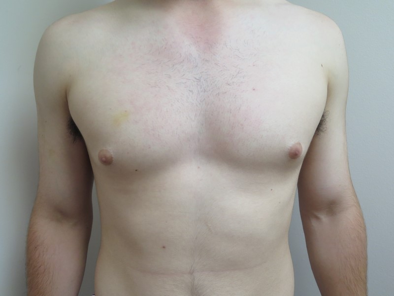 Breast Reduction before and after - before
