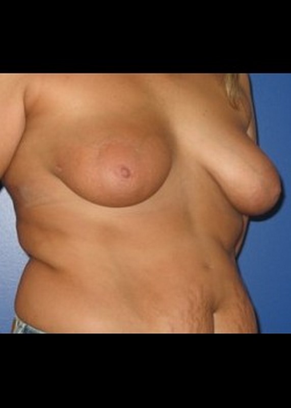 Procedure before and after - before