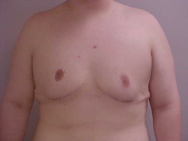 Breast Reduction before and after - after