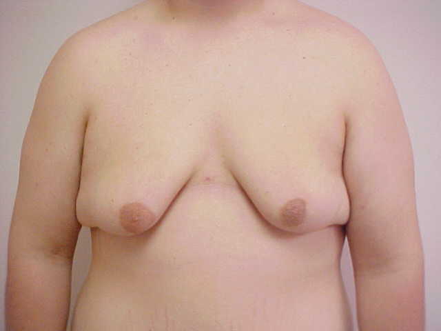 Breast Reduction before and after - before