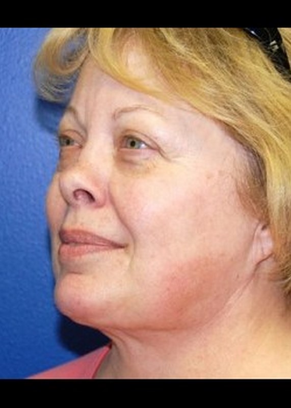 Liposuction before and after - after
