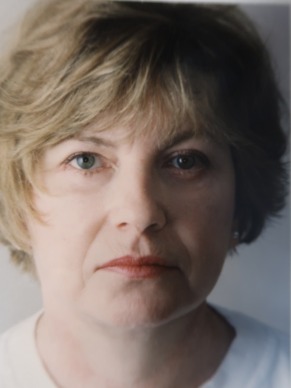 Facelift before and after - after