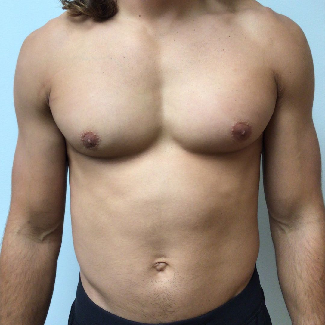 Breast Reduction before and after - after