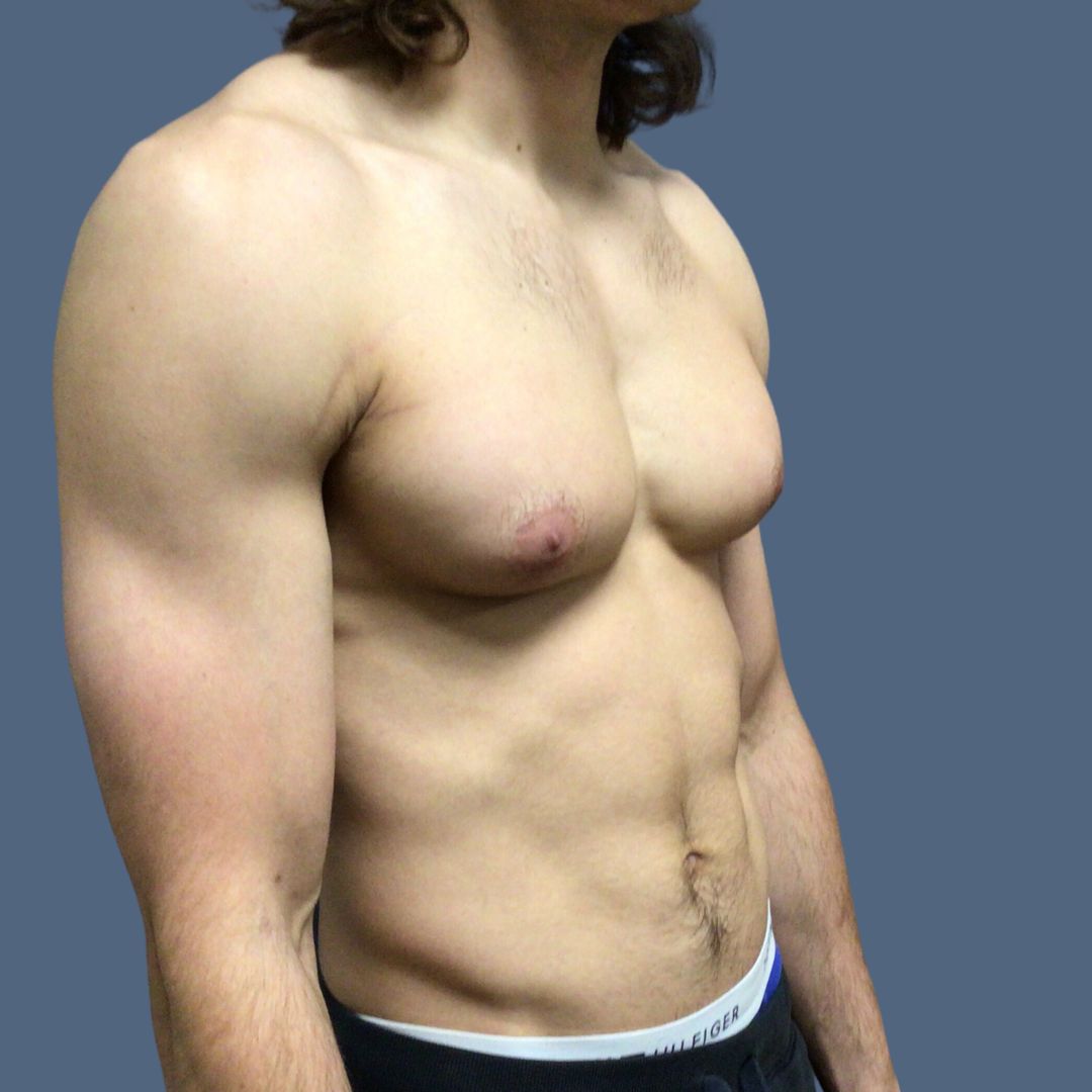 Breast Reduction before and after - before
