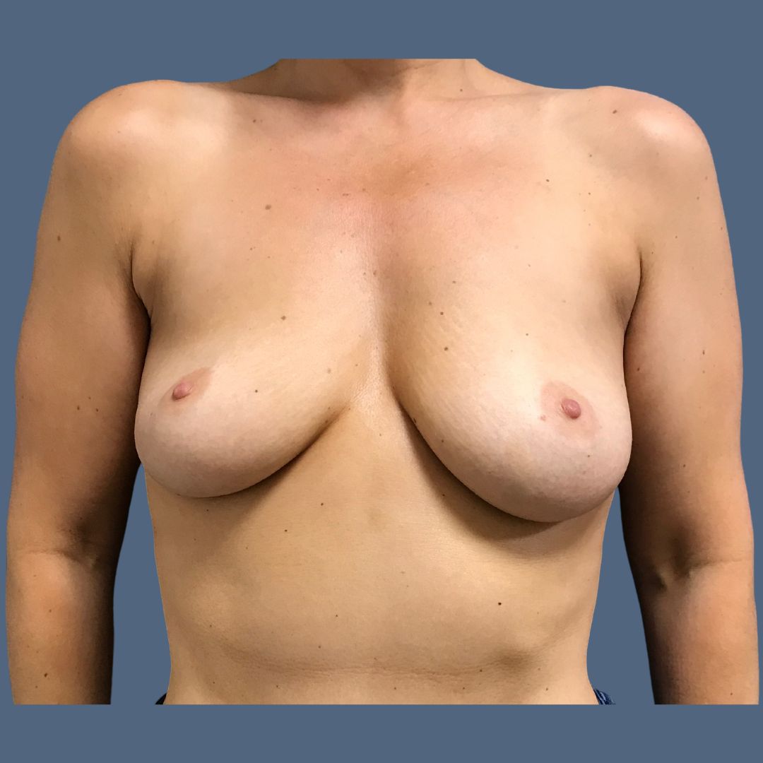Breast Augmentation before and after - before