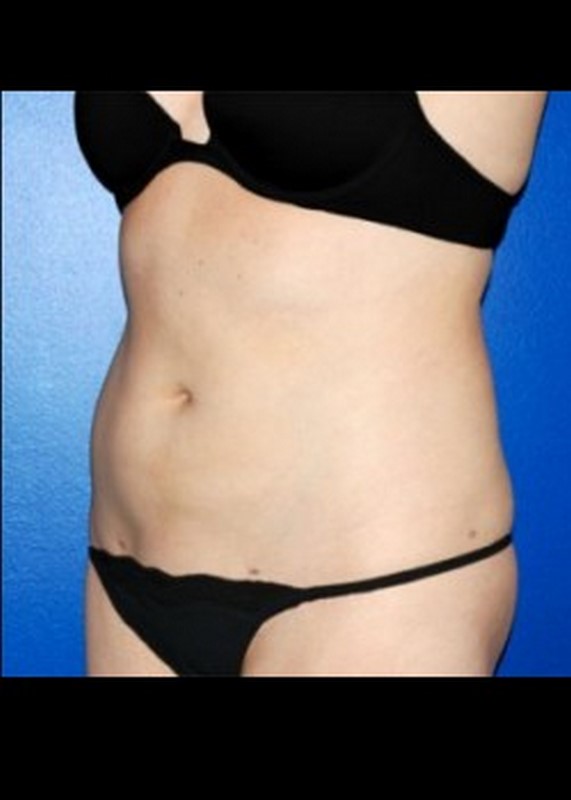 Liposuction before and after - after