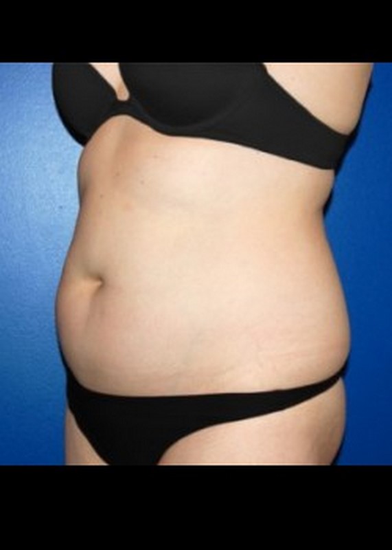 Liposuction before and after - before