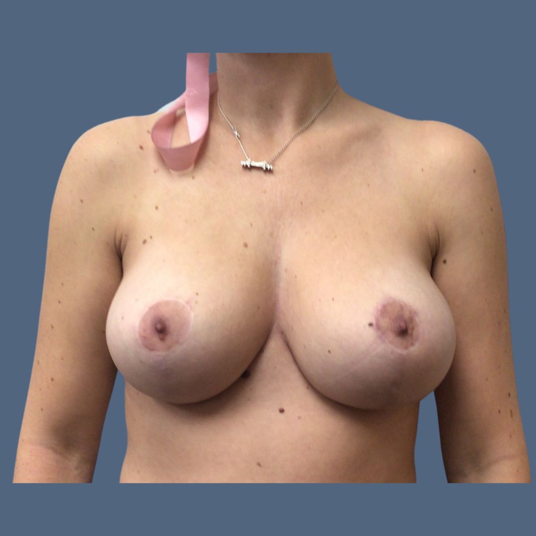Breast Lift before and after - after