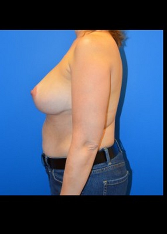 Breast Reduction before and after - after