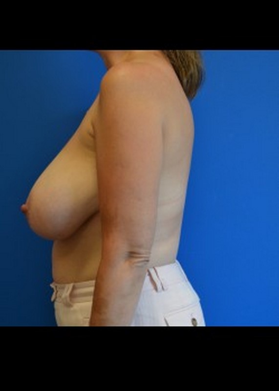 Breast Reduction before and after - before