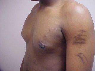 Breast Reduction before and after - after