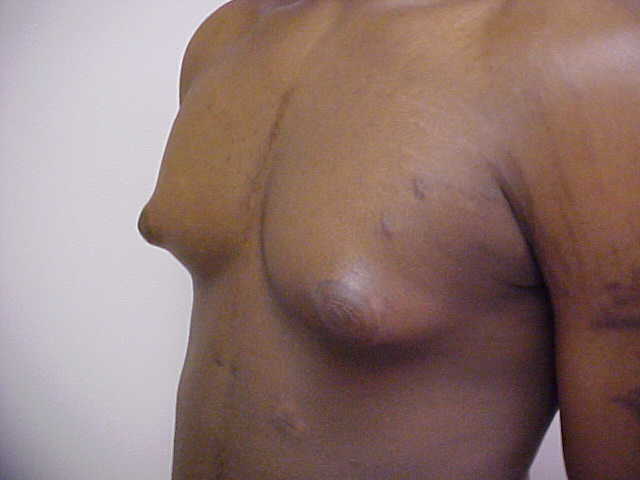Breast Reduction before and after - before