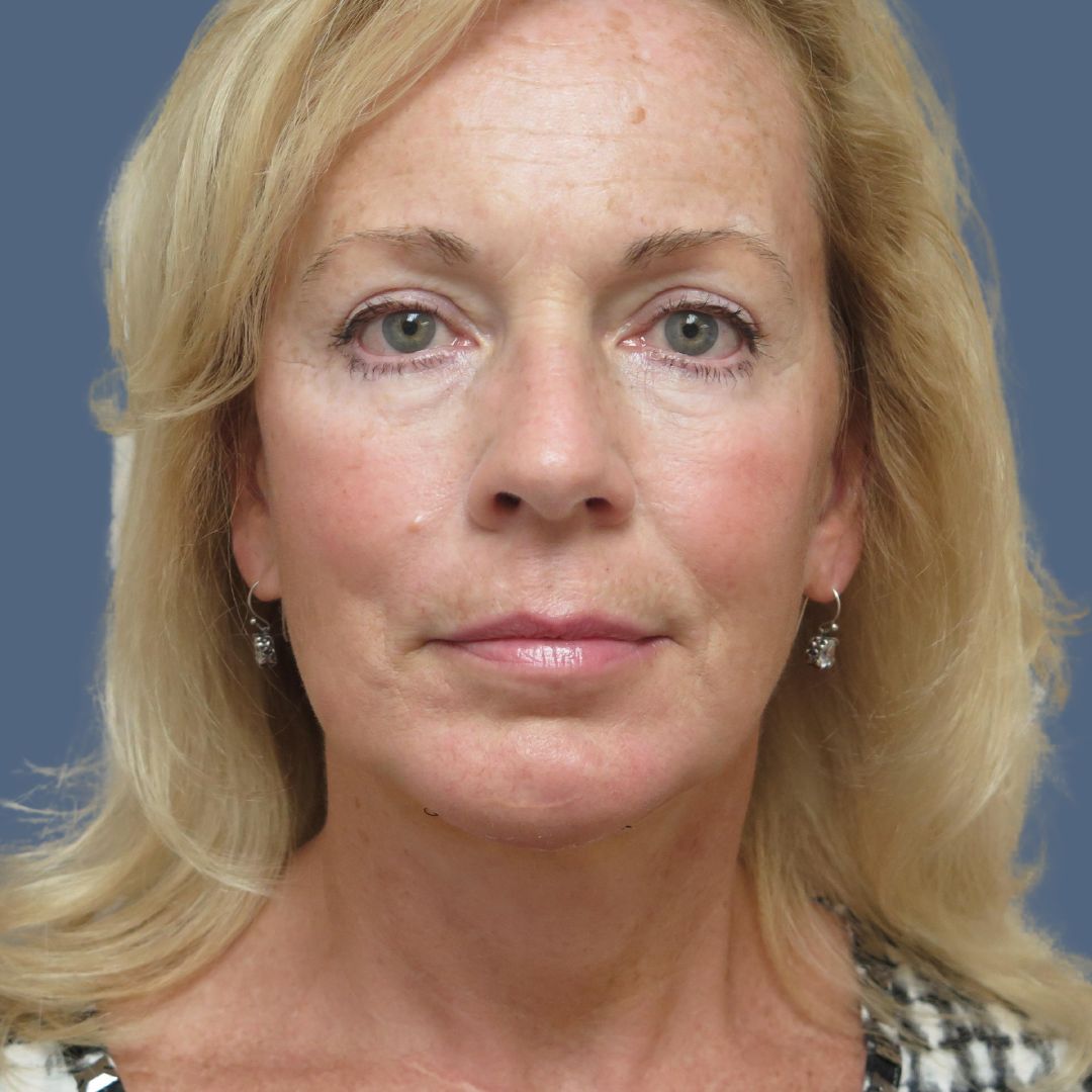 Facelift before and after - after