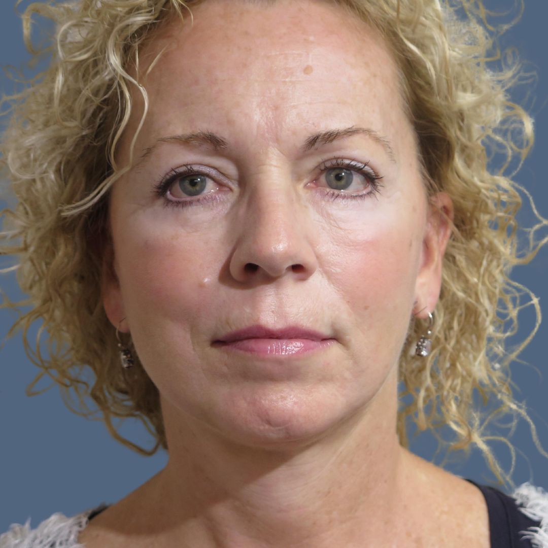 Facelift before and after - before