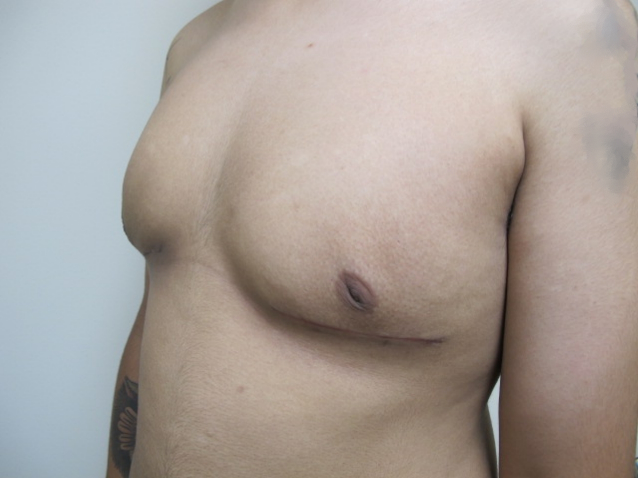 Breast Reduction before and after - after