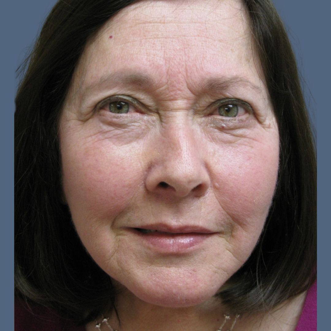 Facelift before and after - after