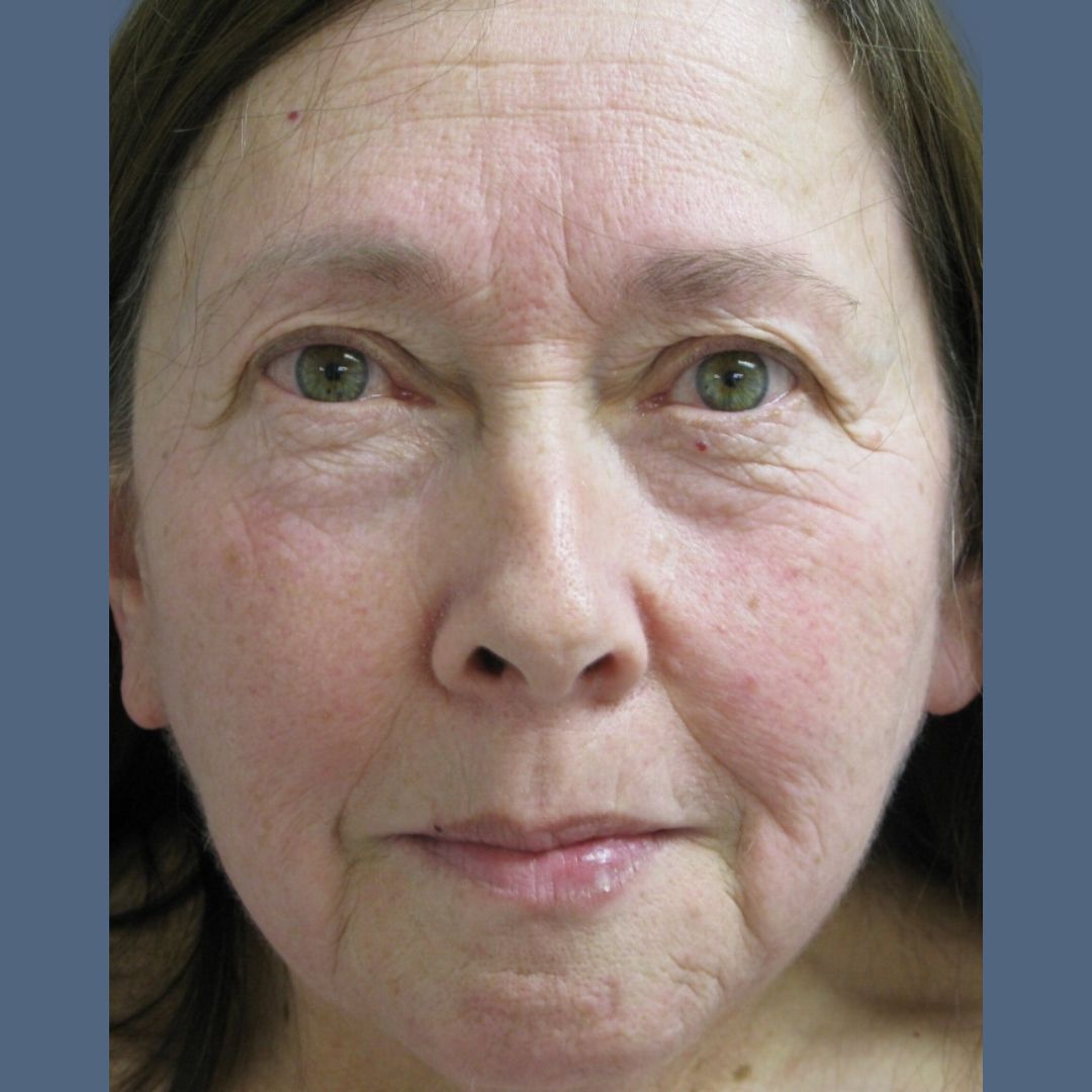 Facelift before and after - before