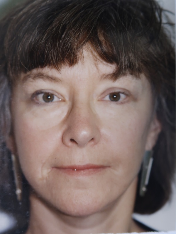 Facelift before and after - after