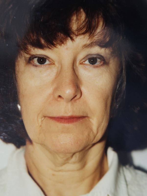 Facelift before and after - before