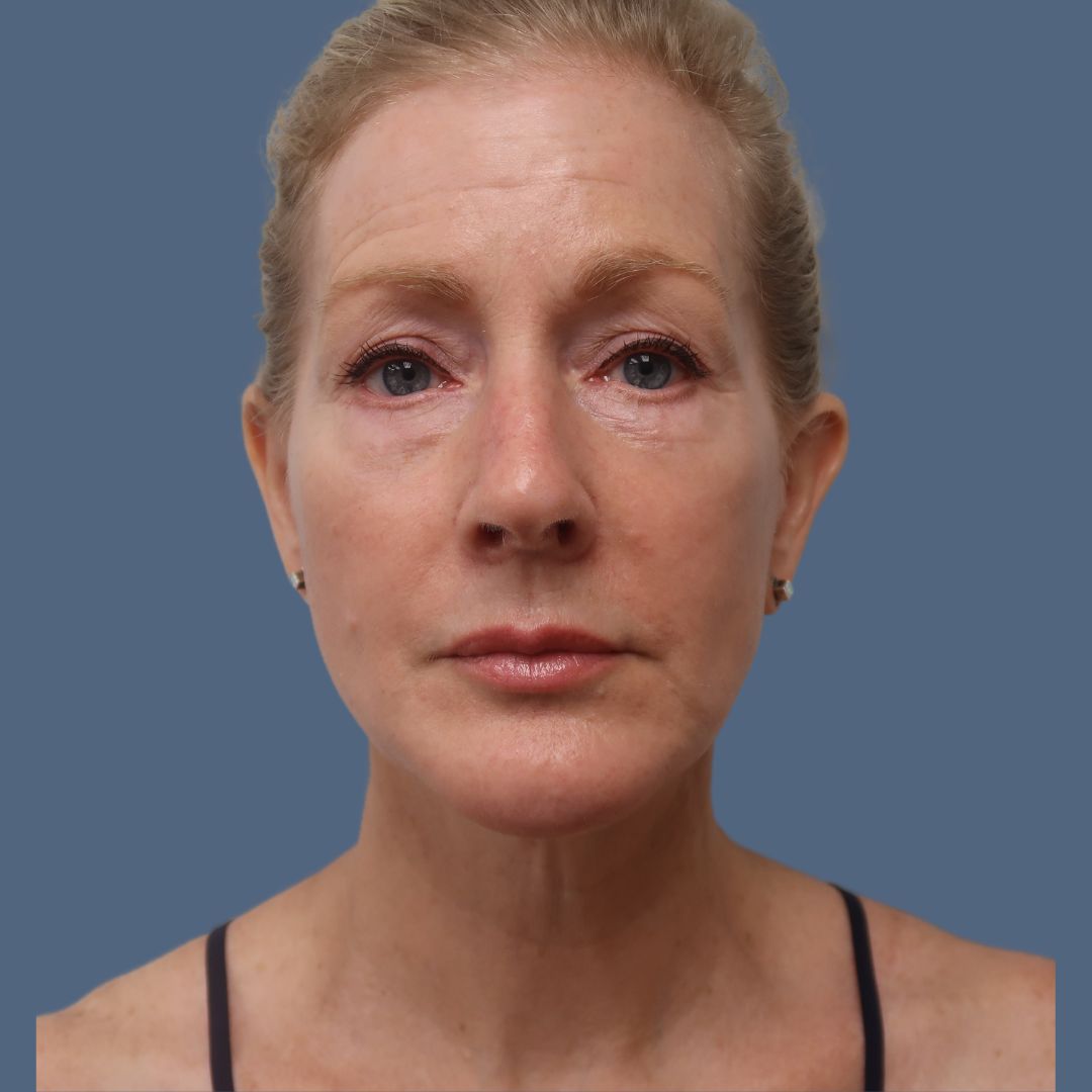 Facelift before and after - after