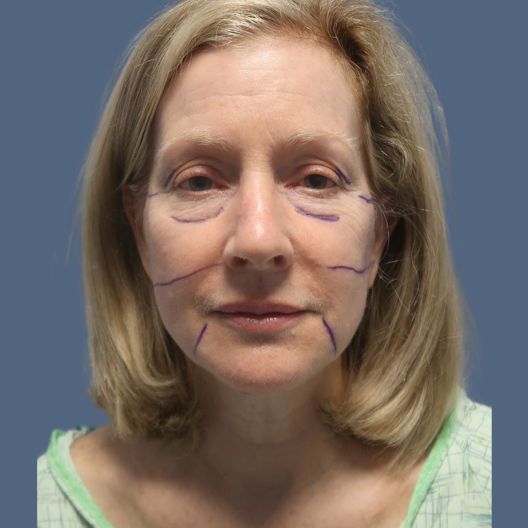 Facelift before and after - before