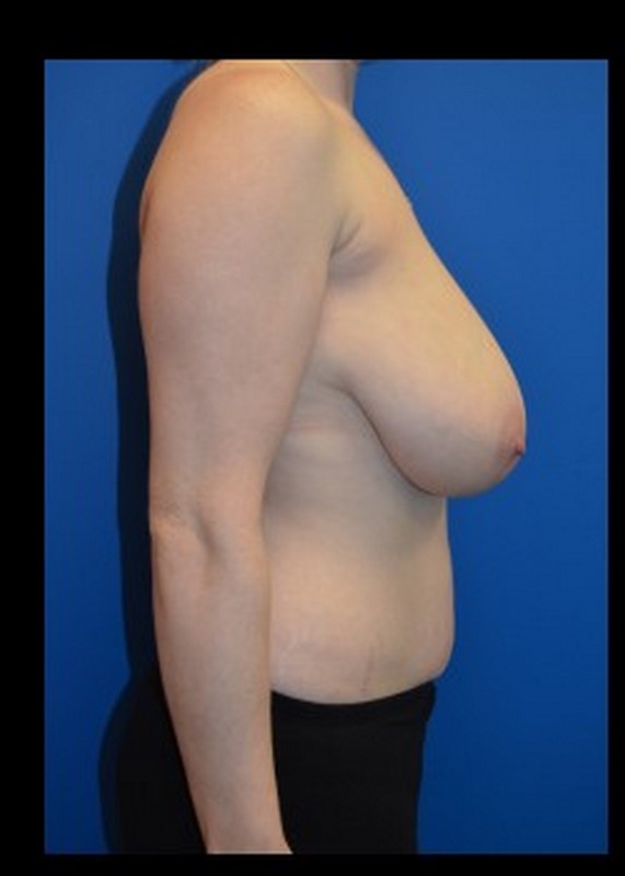 Breast Reduction before and after - before