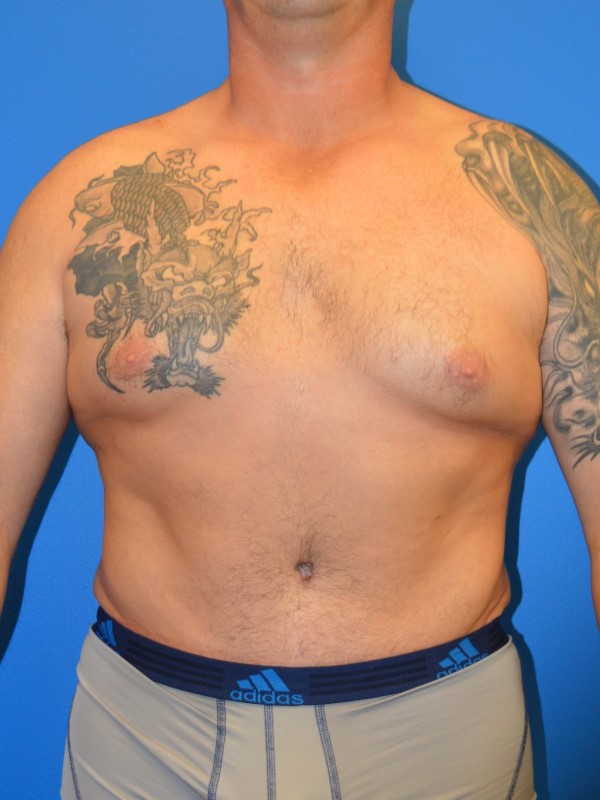 Breast Reduction before and after - after