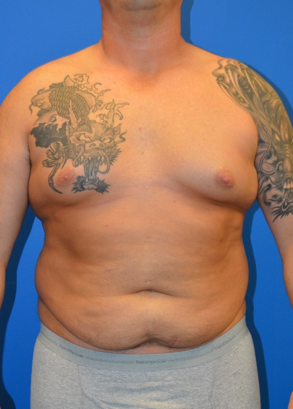 Breast Reduction before and after - before