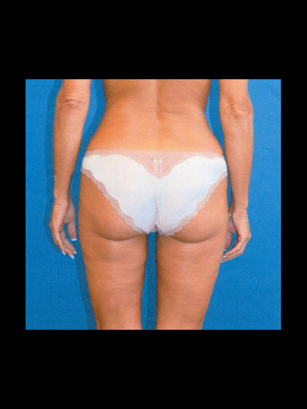 Liposuction before and after - after