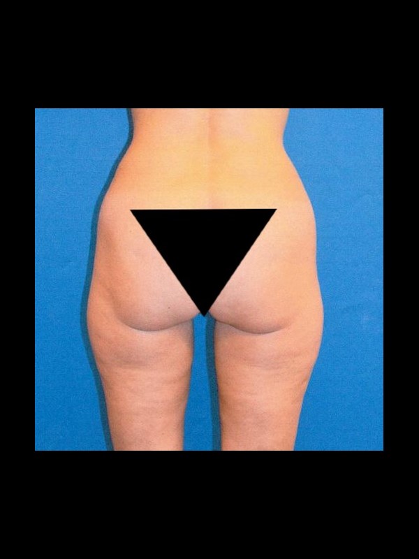 Liposuction before and after - before
